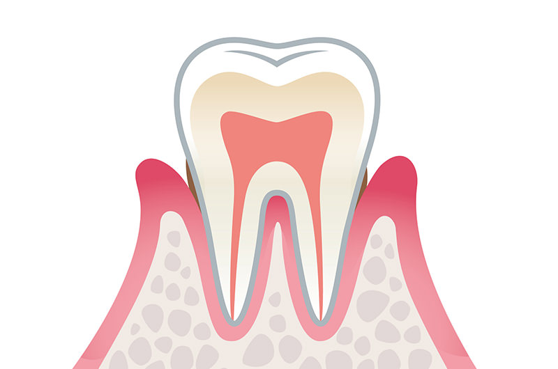 軽度歯周病