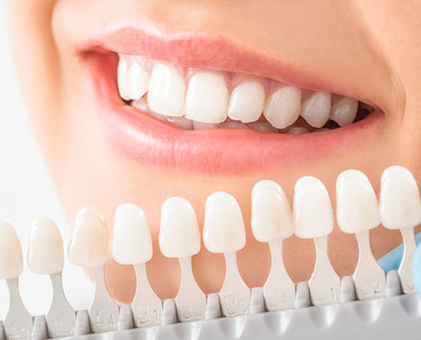 加西市　歯医者　塩谷歯科医院 歯を白くしたい