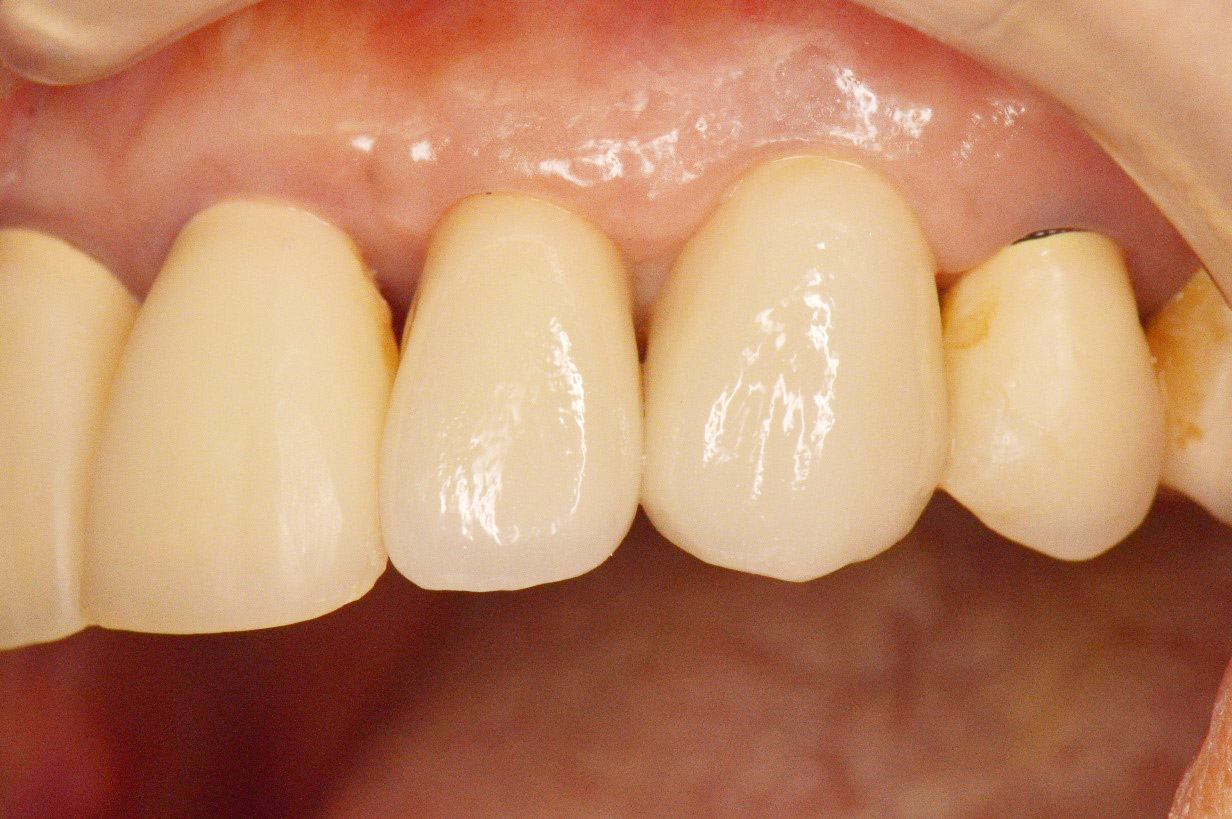 破折歯の保存のために行われる矯正的挺出、歯冠長延長術と補綴治療