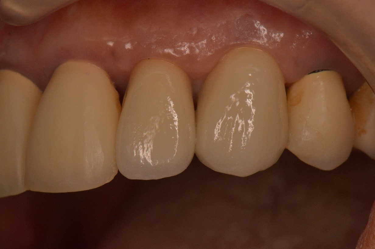 破折歯の保存のために行われる矯正的挺出、歯冠長延長術と補綴治療
