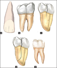 歯の破折図